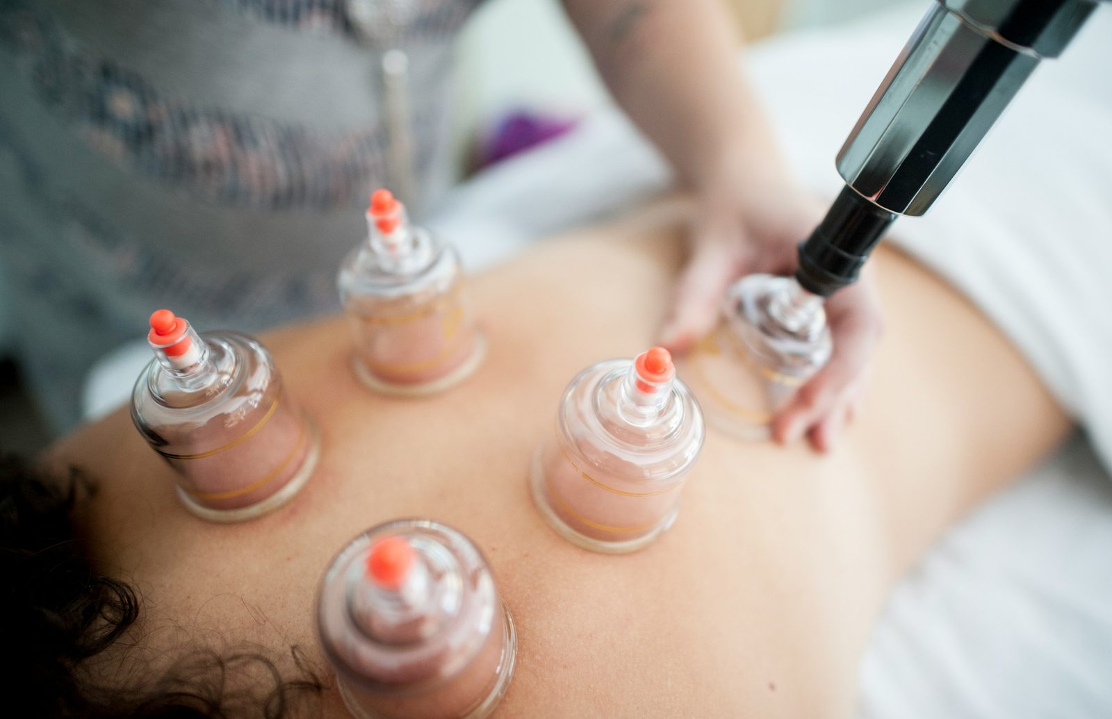 Cupping cups on a patient's back, with a practitioner's hand adjusting one