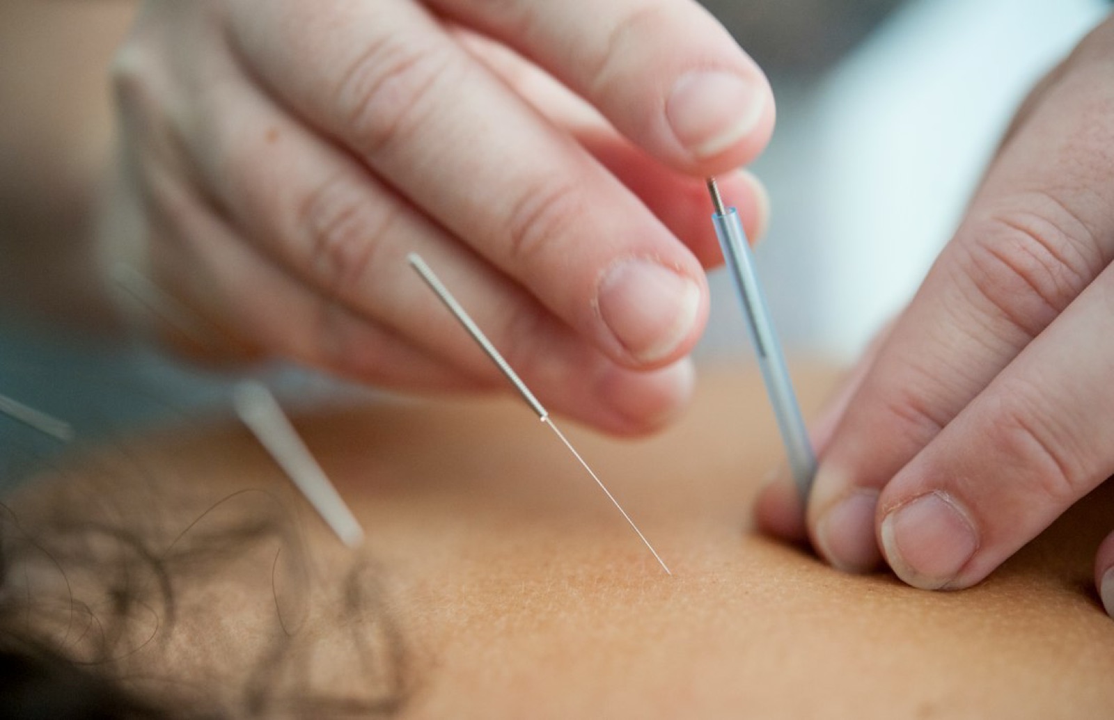 Fine acupuncture needles being placed in the skin of a patient's back